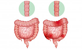Qıcıqlanmış Bağırsaq Sindromu (Irritated Bowel Syndrome - IBS) Qıcıqlanmış Bağırsaq Sindromu (Irritated Bowel Syndrome - IBS)