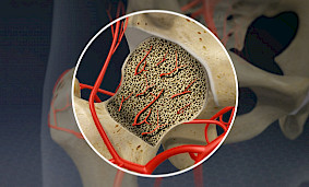 Avilit (Avascular Necrosis): Nədir və Niyə Diqqət Edilməlidir? Avilit (Avascular Necrosis): Nədir və Niyə Diqqət Edilməlidir?